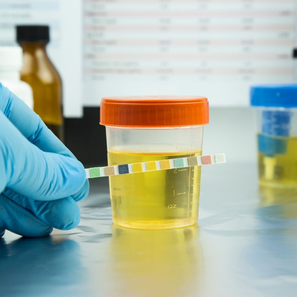 Химични и цитологични изследвания на урина